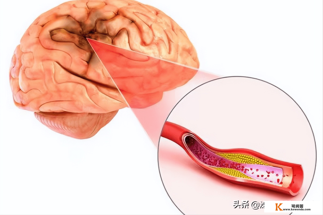 为何中国的脑梗越来越多？医生：不要只弥补叶酸，做好那3点更重