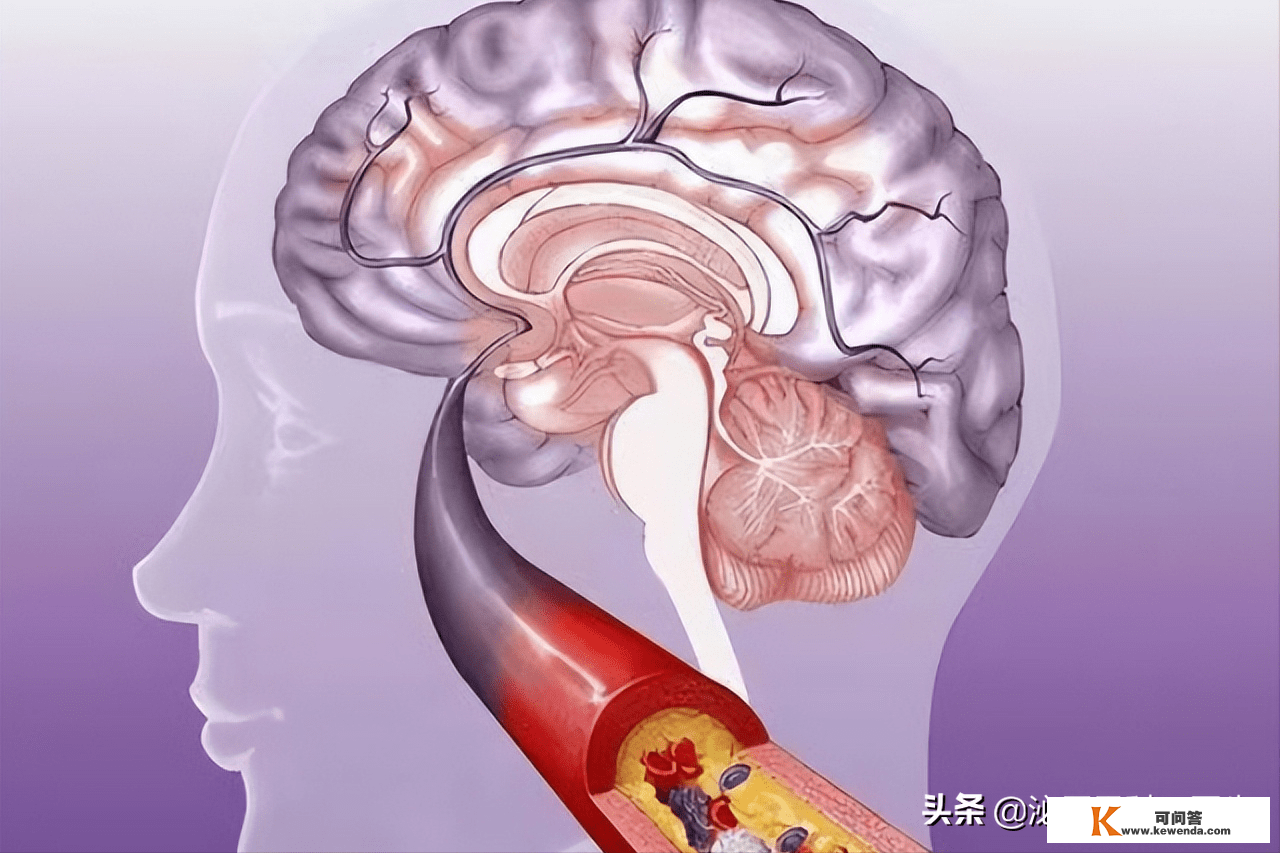 为何中国的脑梗越来越多？医生：不要只弥补叶酸，做好那3点更重