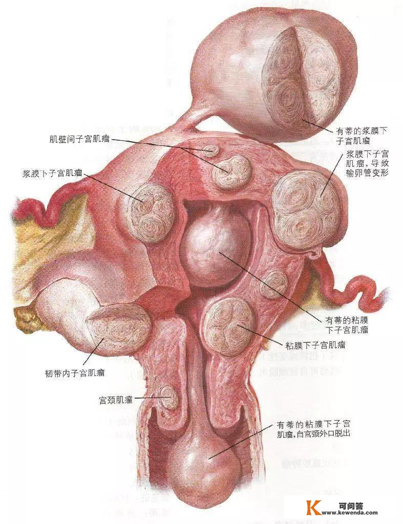 子宫肌瘤是怎么构成的？