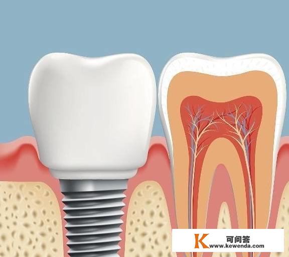 种植牙的巩固水平跟实牙比拟若何