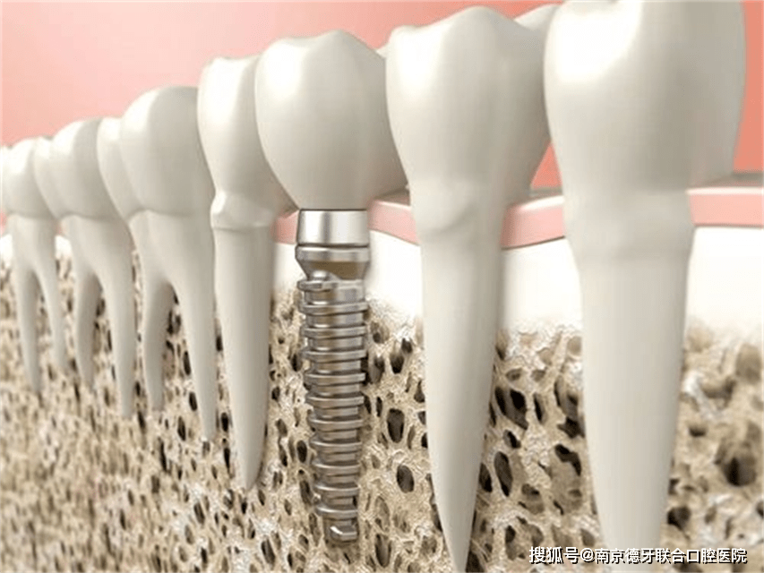 南京德牙结合口腔病院：种植牙更大的缺点是什么？