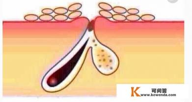 关于痘痘的电影 关于痘痘的电影